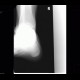 Fracture of tarsal bones: X-ray - Plain radiograph